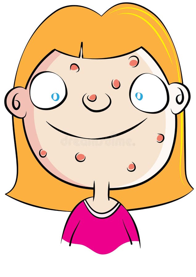 Cute white girl with acne problem royalty free illustration